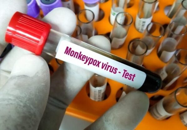 Одесская область получила первую партию тестов для диагностики оспы обезьян Одесская область получила первую партию тестов для диагностики оспы обезьян